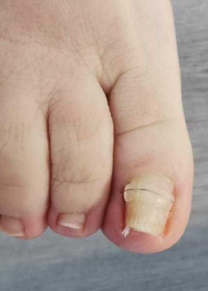 L’orthonyxie, un traitement de l’ongle incarné par votre pédicure-podologue à Arpajon 